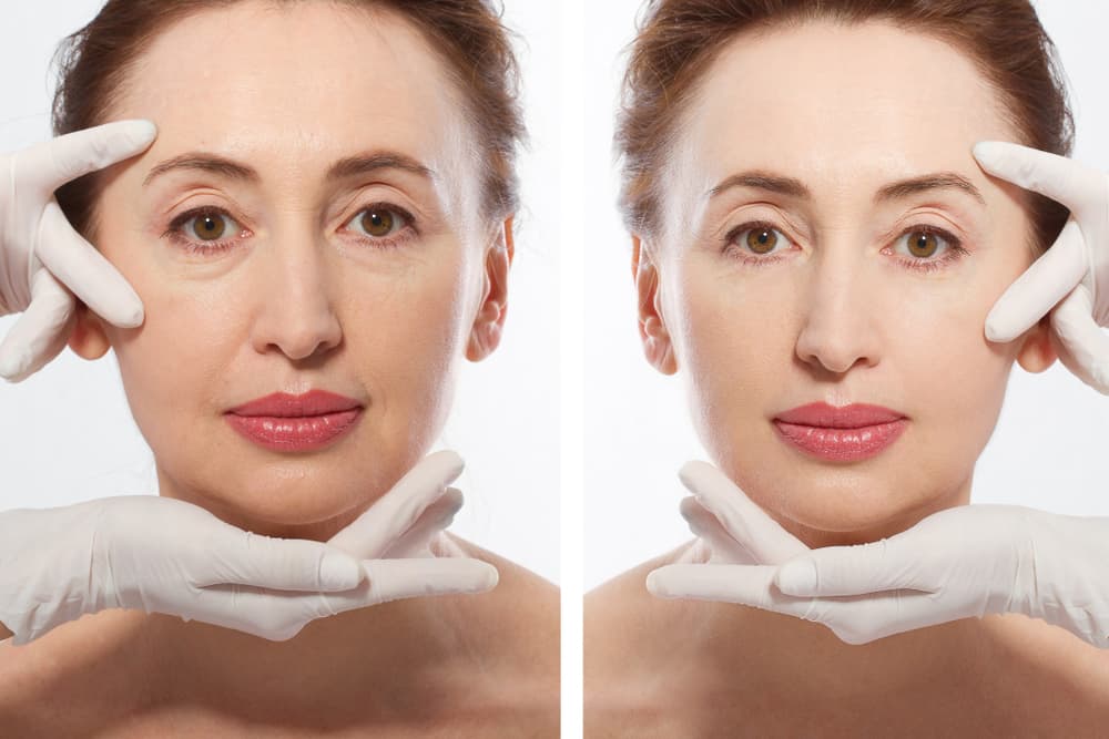 Mini Facelift Procedure in Houston Benefits, Cost, and Recovery